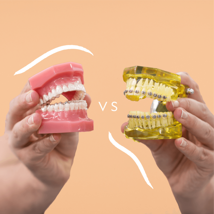 Niềng Răng vs. Invisalign: Cái Nào Phù Hợp Với Bạn?