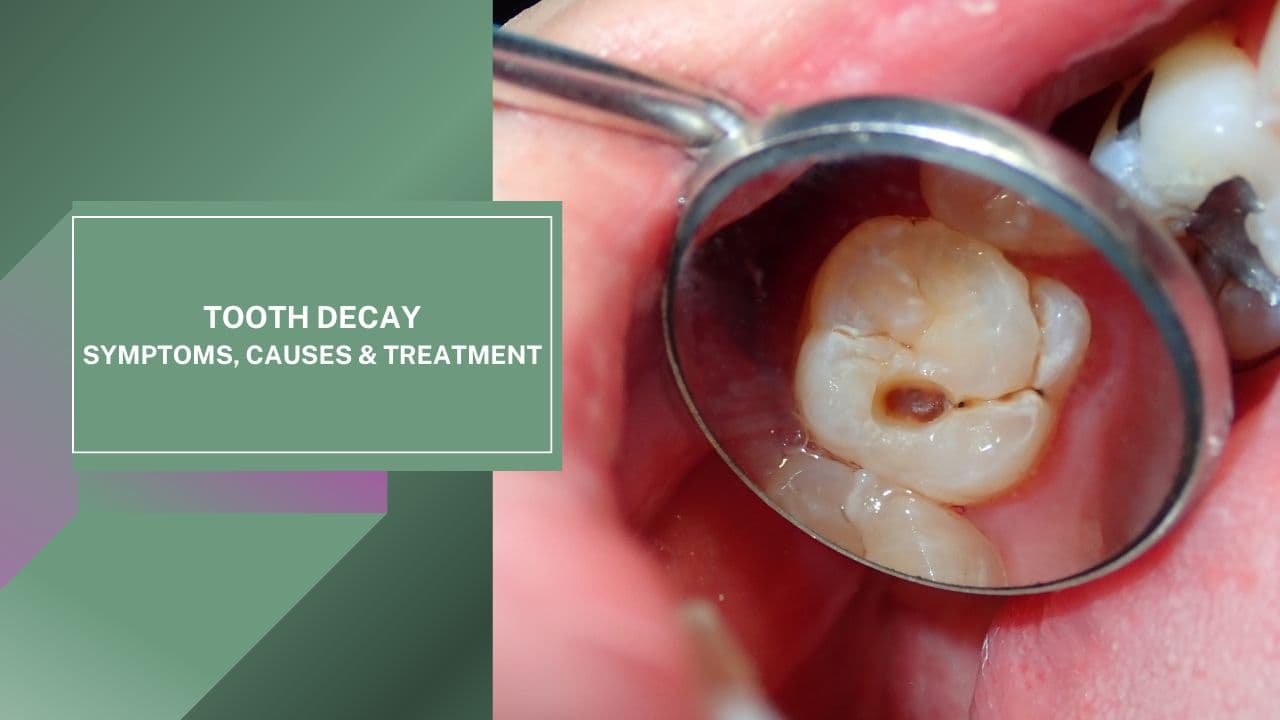 Sâu Răng: Triệu Chứng, Nguyên Nhân và Cách Điều Trị