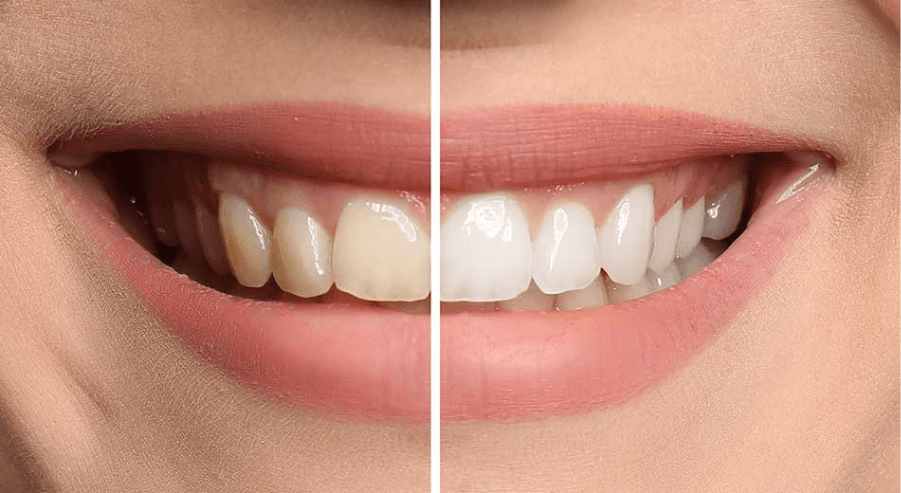 Dán sứ veneer vs. Tẩy trắng răng: Lựa chọn nào bền lâu hơn?